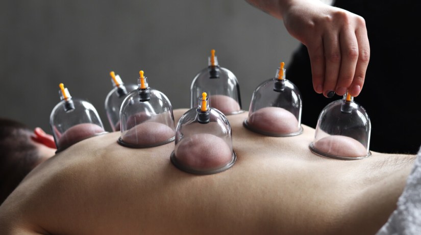 Cupping op rug